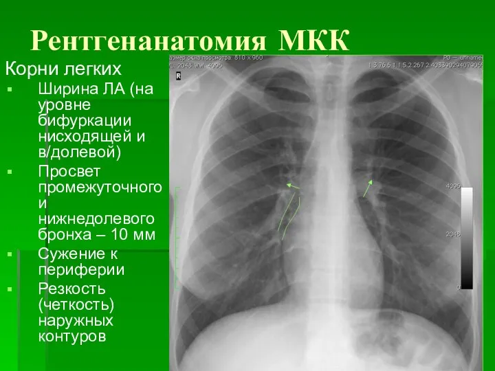 Рентгенанатомия МКК Корни легких Ширина ЛА (на уровне бифуркации нисходящей и в/долевой)