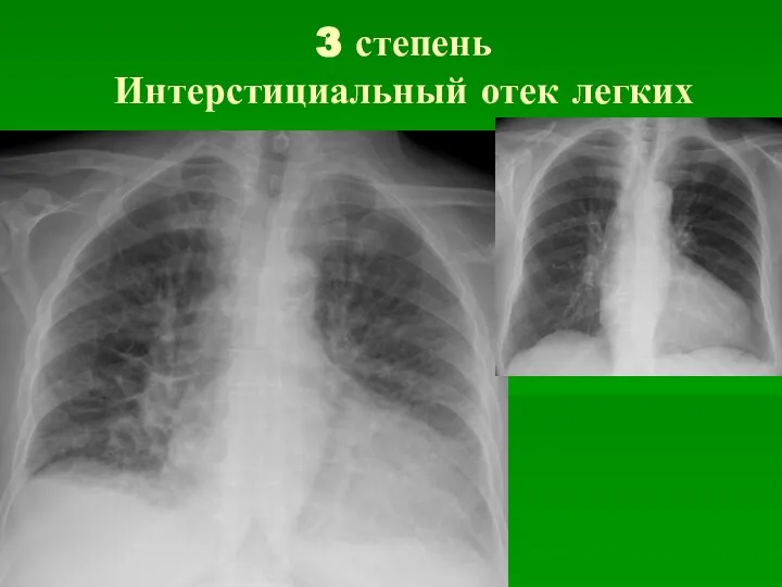 3 степень Интерстициальный отек легких