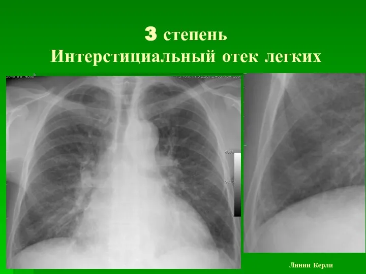 3 степень Интерстициальный отек легких Линии Керли