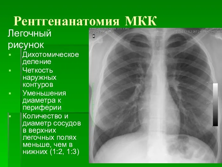 Рентгенанатомия МКК Легочный рисунок Дихотомическое деление Четкость наружных контуров Уменьшения диаметра к