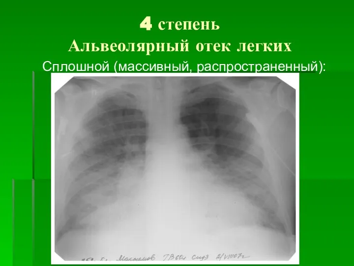 4 степень Альвеолярный отек легких Сплошной (массивный, распространенный):