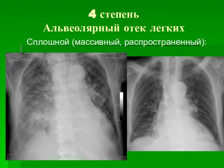 4 степень Альвеолярный отек легких Сплошной (массивный, распространенный):