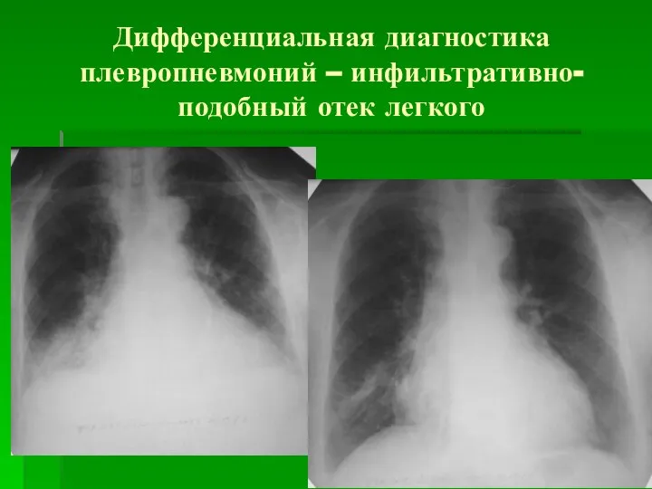 Дифференциальная диагностика плевропневмоний – инфильтративно-подобный отек легкого