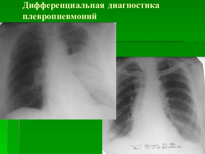 Дифференциальная диагностика плевропневмоний