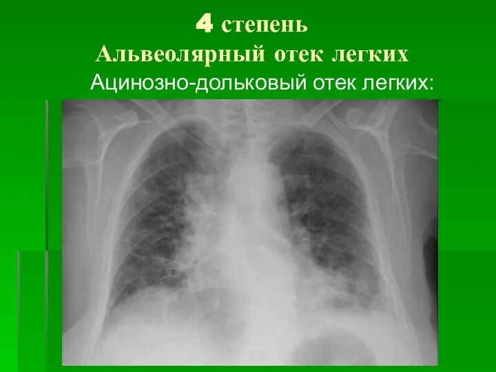 4 степень Альвеолярный отек легких Ацинозно-дольковый отек легких: