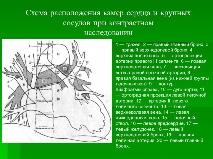 Схема расположения камер сердца и крупных сосудов при контрастном исследовании 1 —