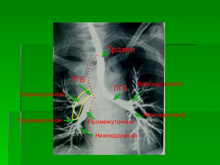 Трахея ПГБ ЛГБ Верхнедолевой Нижнедолевой Верхнедолевой Нижнедолевой Промежуточный Среднедолевой