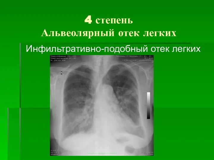 4 степень Альвеолярный отек легких Инфильтративно-подобный отек легких