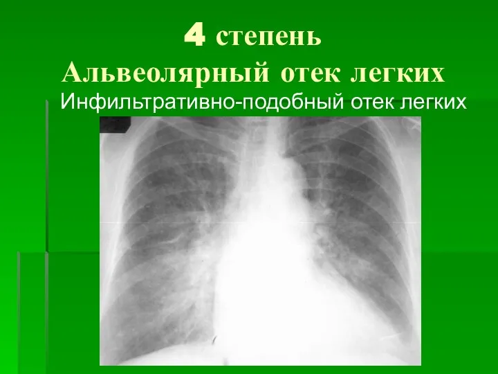 4 степень Альвеолярный отек легких Инфильтративно-подобный отек легких