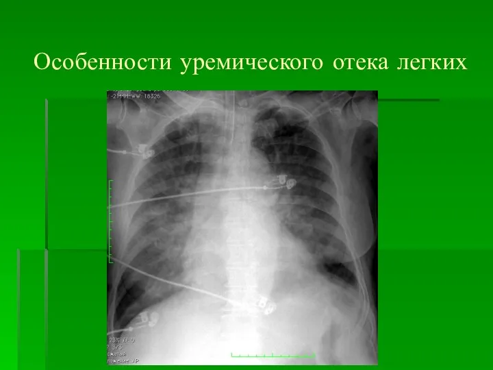 Особенности уремического отека легких