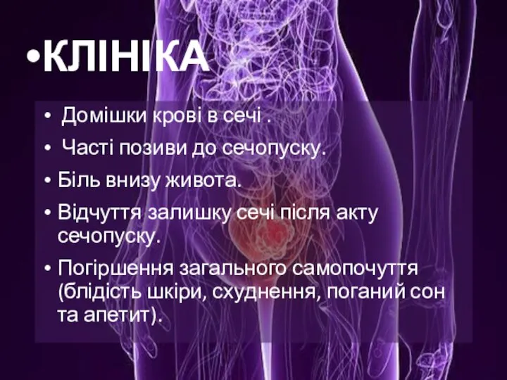 КЛІНІКА Домішки крові в сечі . Часті позиви до сечопуску. Біль внизу