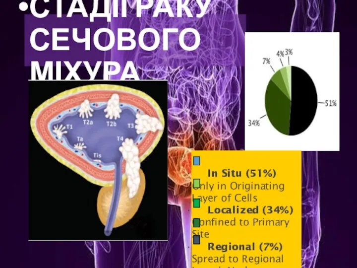 СТАДІЇ РАКУ СЕЧОВОГО МІХУРА In Situ (51%) Only in Originating Layer of