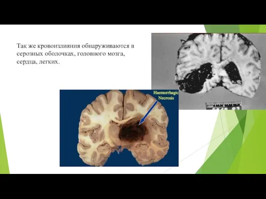 Так же кровоизлияния обнаруживаются в серозных оболочках, головного мозга, сердца, легких.