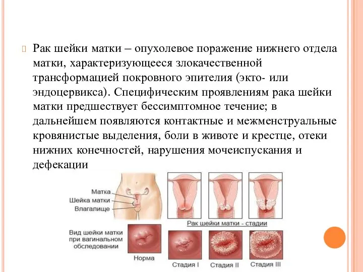 Рак шейки матки – опухолевое поражение нижнего отдела матки, характеризующееся злокачественной трансформацией