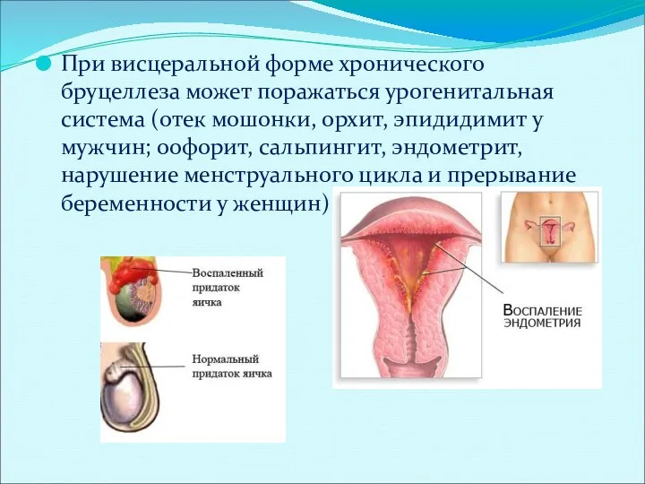 При висцеральной форме хронического бруцеллеза может поражаться урогенитальная система (отек мошонки, орхит,