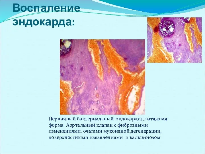 Воспаление эндокарда: Первичный бактериальный эндокардит, затяжная форма. Аортальный клапан с фиброзными изменениями,