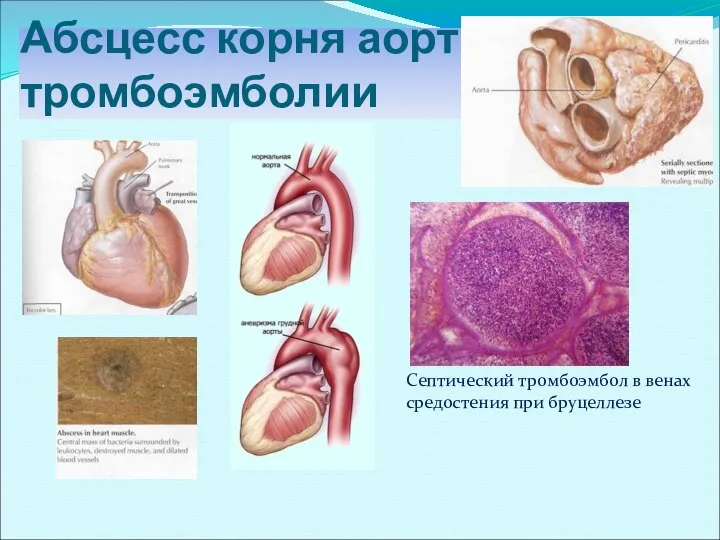 Абсцесс корня аорты, тромбоэмболии Септический тромбоэмбол в венах средостения при бруцеллезе