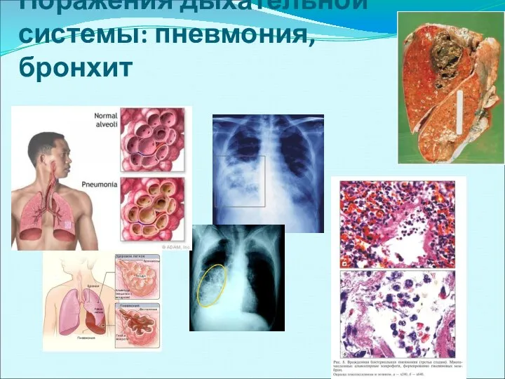 Поражения дыхательной системы: пневмония, бронхит