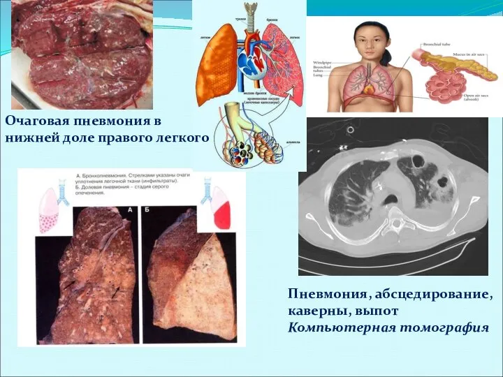 Пневмония, абсцедирование, каверны, выпот Компьютерная томография Очаговая пневмония в нижней доле правого легкого