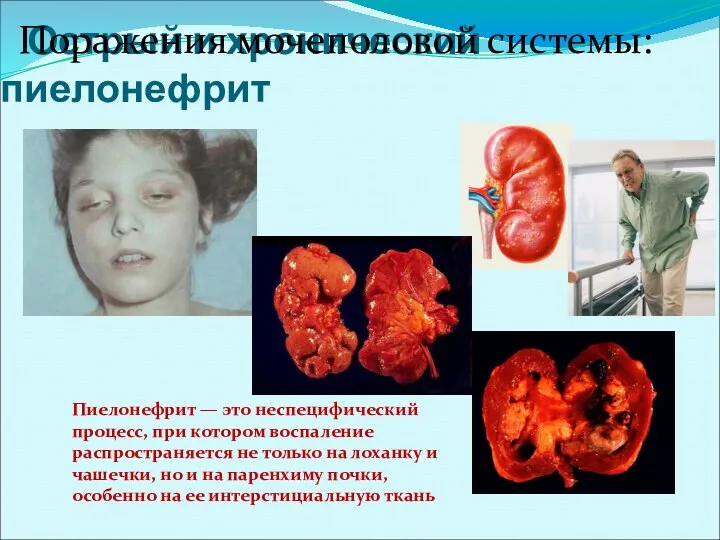 Острый и хронический пиелонефрит Пиелонефрит — это неспецифический процесс, при котором воспаление