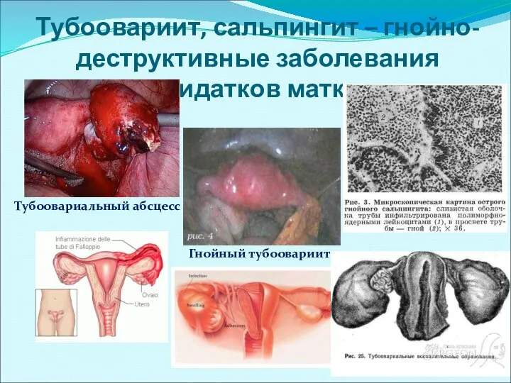 Тубоовариит, сальпингит – гнойно-деструктивные заболевания придатков матки: Тубоовариальный абсцесс Гнойный тубоовариит