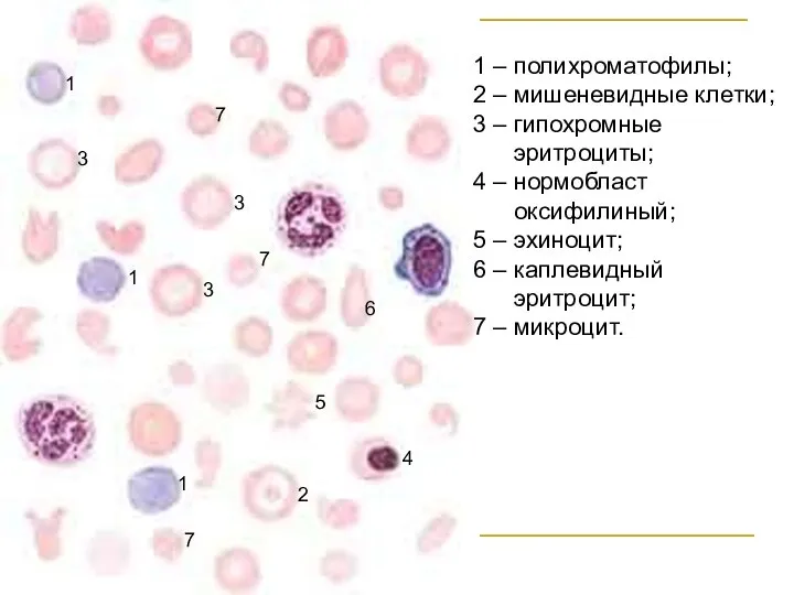 1 – полихроматофилы; 2 – мишеневидные клетки; 3 – гипохромные эритроциты; 4