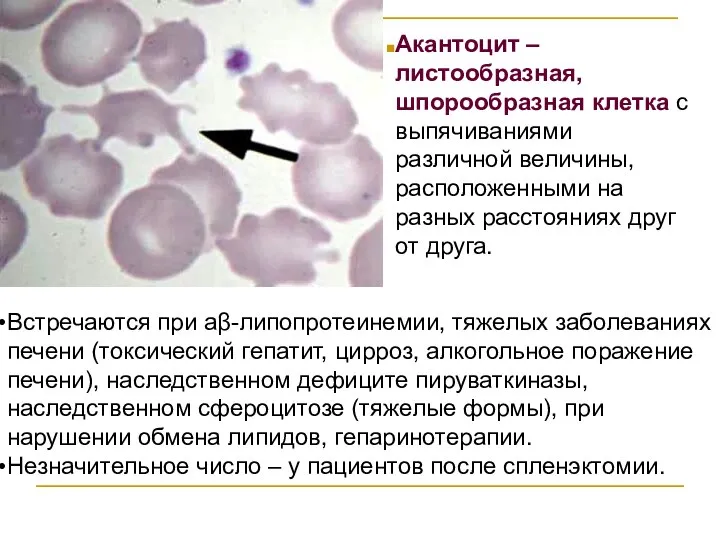 Акантоцит – листообразная, шпорообразная клетка с выпячиваниями различной величины, расположенными на разных