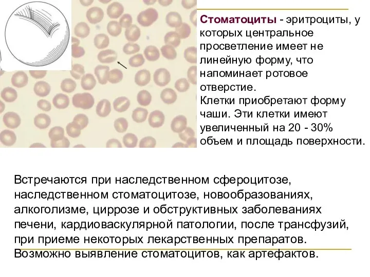 Стоматоциты - эритроциты, у которых центральное просветление имеет не линейную форму, что