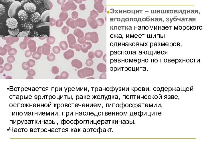 Эхиноцит – шишковидная, ягодоподобная, зубчатая клетка напоминает морского ежа, имеет шипы одинаковых