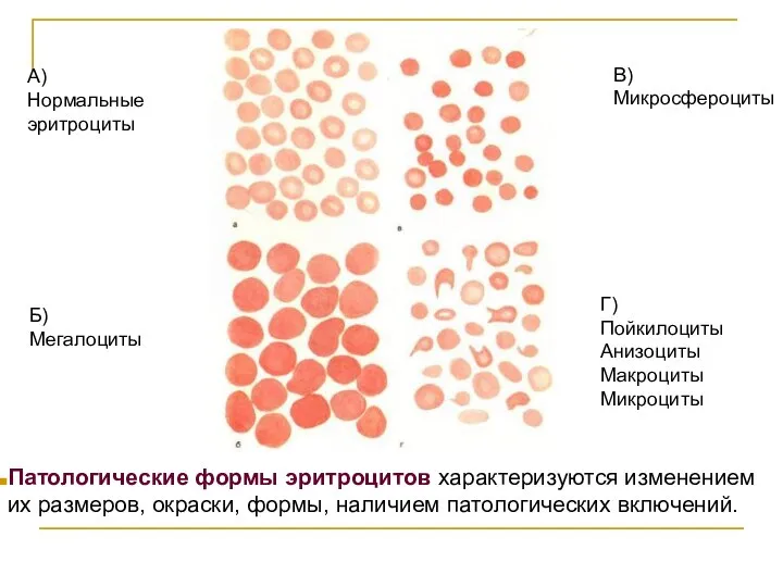 А) Нормальные эритроциты Б) Мегалоциты В) Микросфероциты Г) Пойкилоциты Анизоциты Макроциты Микроциты