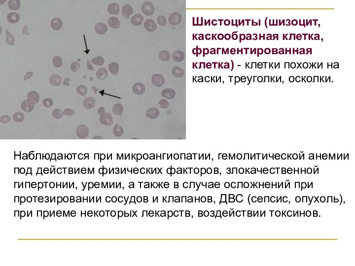 Наблюдаются при микроангиопатии, гемолитической анемии под действием физических факторов, злокачественной гипертонии, уремии,