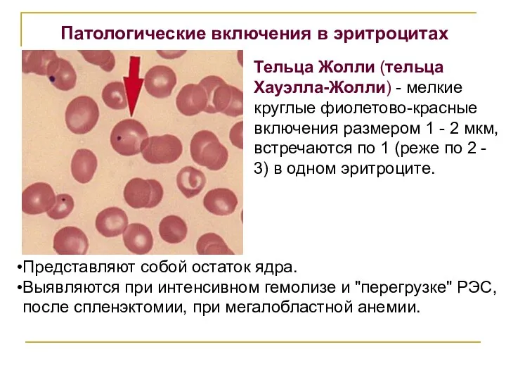 Представляют собой остаток ядра. Выявляются при интенсивном гемолизе и "перегрузке" РЭС, после