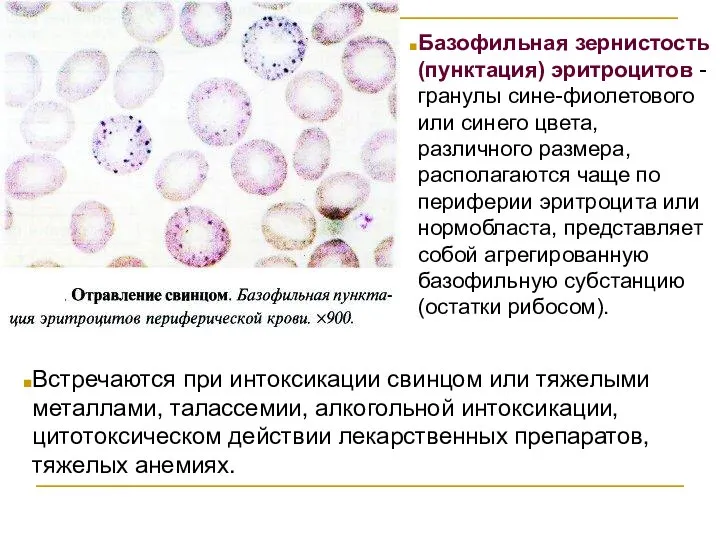 Базофильная зернистость (пунктация) эритроцитов - гранулы сине-фиолетового или синего цвета, различного размера,