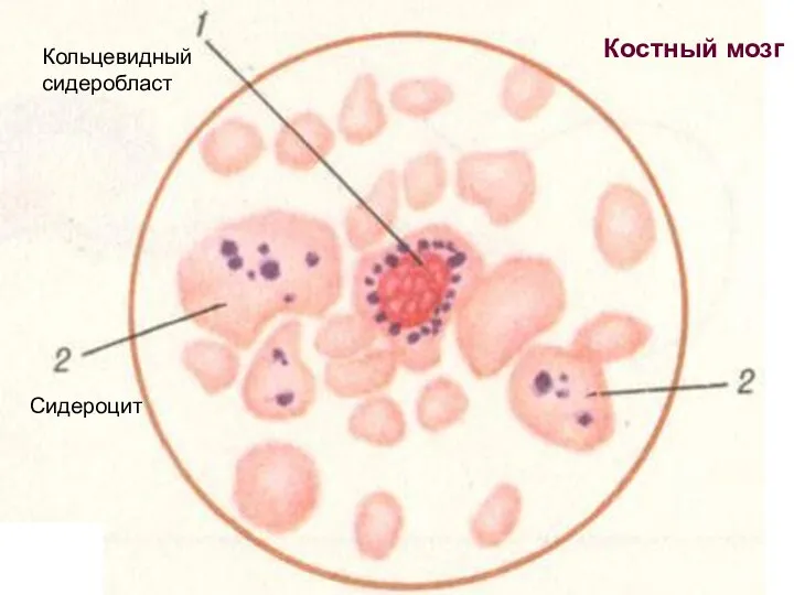 Кольцевидный сидеробласт Сидероцит Костный мозг