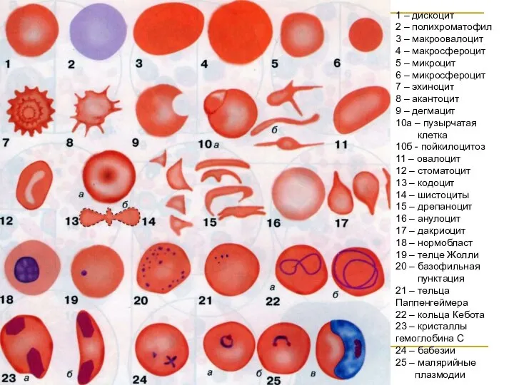 1 – дискоцит 2 – полихроматофил 3 – макроовалоцит 4 – макросфероцит