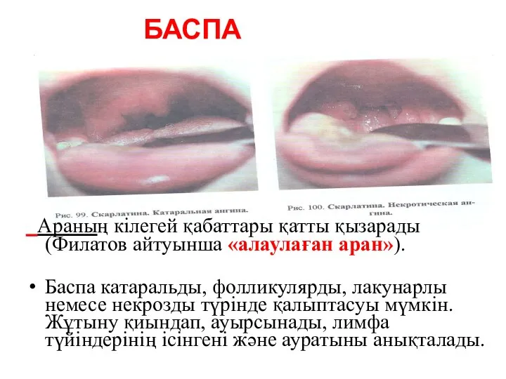 БАСПА Араның кілегей қабаттары қатты қызарады (Филатов айтуынша «алаулаған аран»). Баспа катаральды,