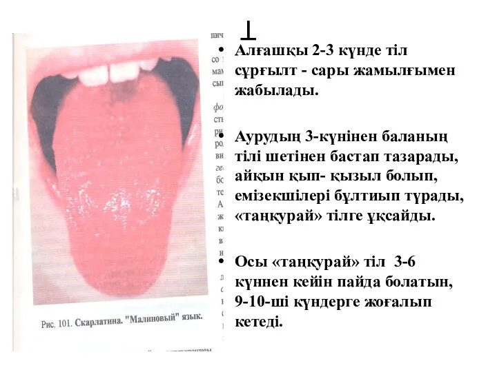 Т Алғашқы 2-3 күнде тіл сұрғылт - сары жамылғымен жабылады. Аурудың 3-күнінен