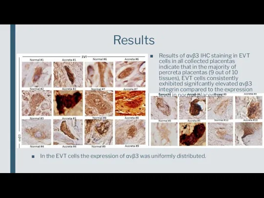 Results Results of αvβ3 IHC staining in EVT cells in all collected