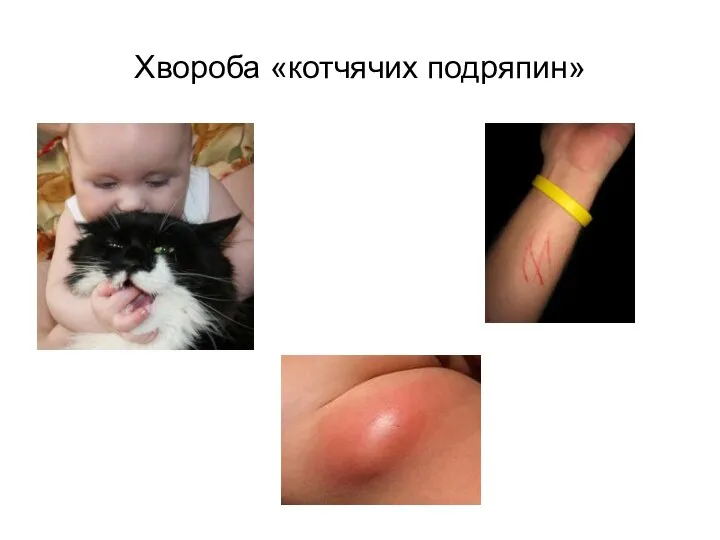 Хвороба «котчячих подряпин»