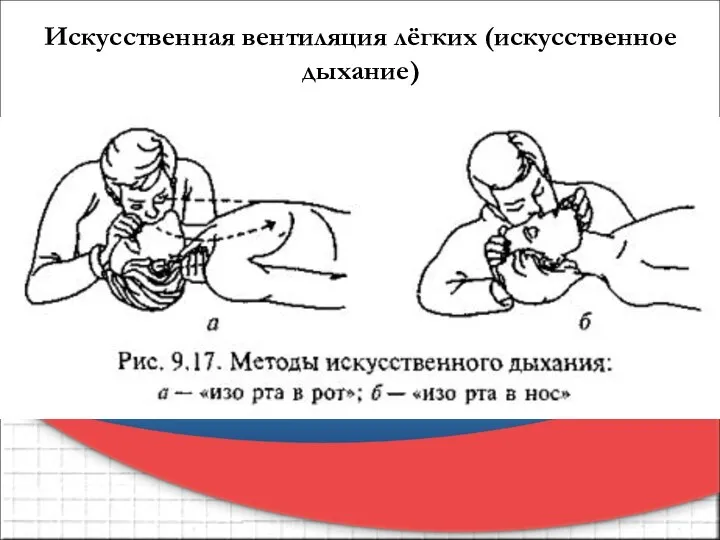 Искусственная вентиляция лёгких (искусственное дыхание)