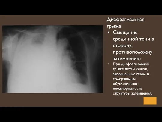 Диафрагмальная грыжа Смещение срединной тени в сторону, противоположну затемнению При диафрагмальной грыже