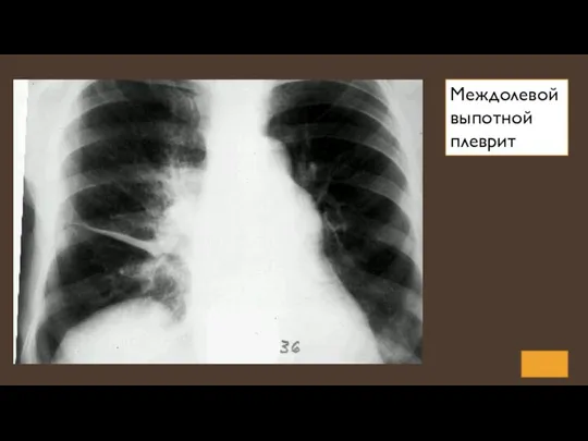 Междолевой выпотной плеврит