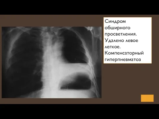 Синдром обширного просветления. Удалено левое легкое. Компенсаторный гиперпневматоз