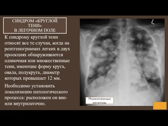 СИНДРОМ «КРУГЛОЙ ТЕНИ» В ЛЕГОЧНОМ ПОЛЕ К синдрому круглой тени относят все