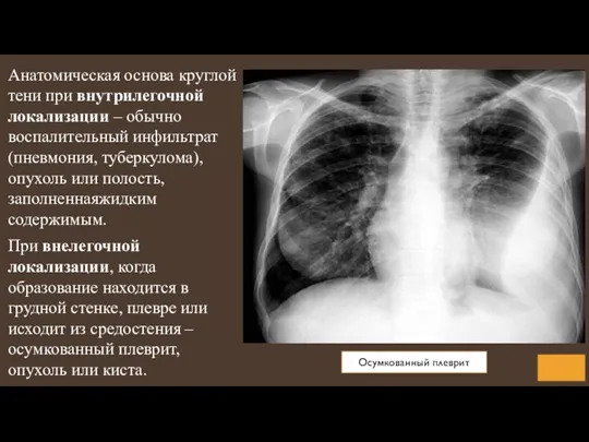 Анатомическая основа круглой тени при внутрилегочной локализации – обычно воспалительный инфильтрат (пневмония,