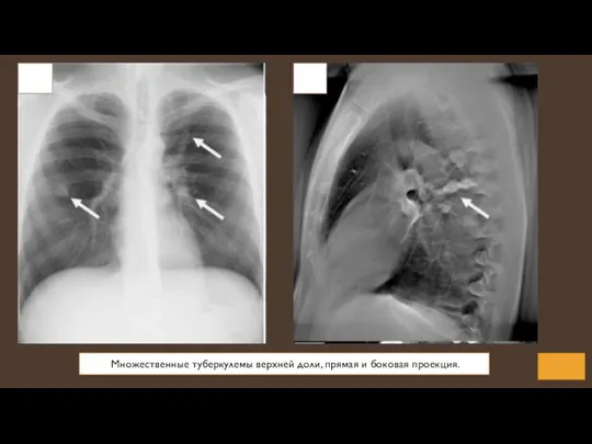 Множественные туберкулемы верхней доли, прямая и боковая проекция.