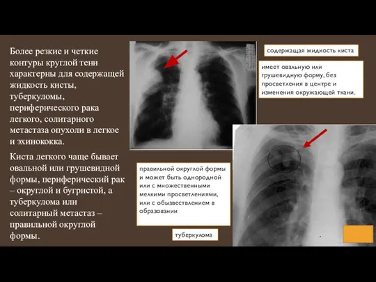 Более резкие и четкие контуры круглой тени характерны для содержащей жидкость кисты,