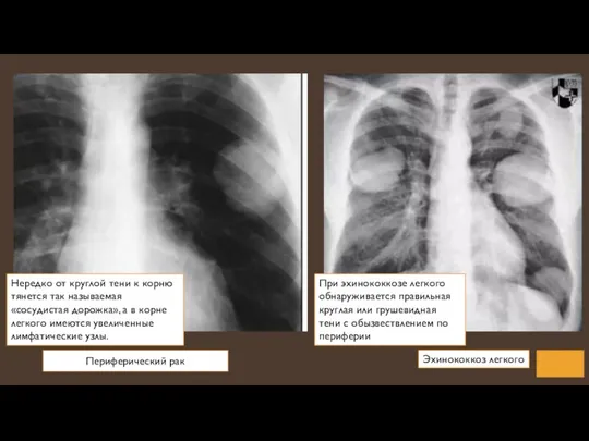 Периферический рак Эхинококкоз легкого Нередко от круглой тени к корню тянется так