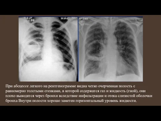 При абсцессе легкого на рентгенограмме видна четко очерченная полость с равномерно толстыми