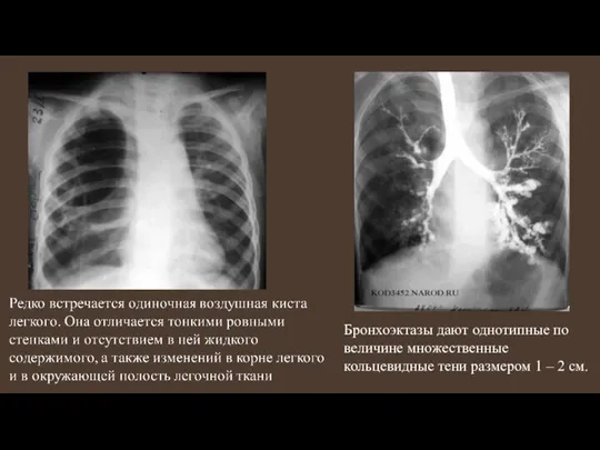 Бронхоэктазы дают однотипные по величине множественные кольцевидные тени размером 1 – 2 см.